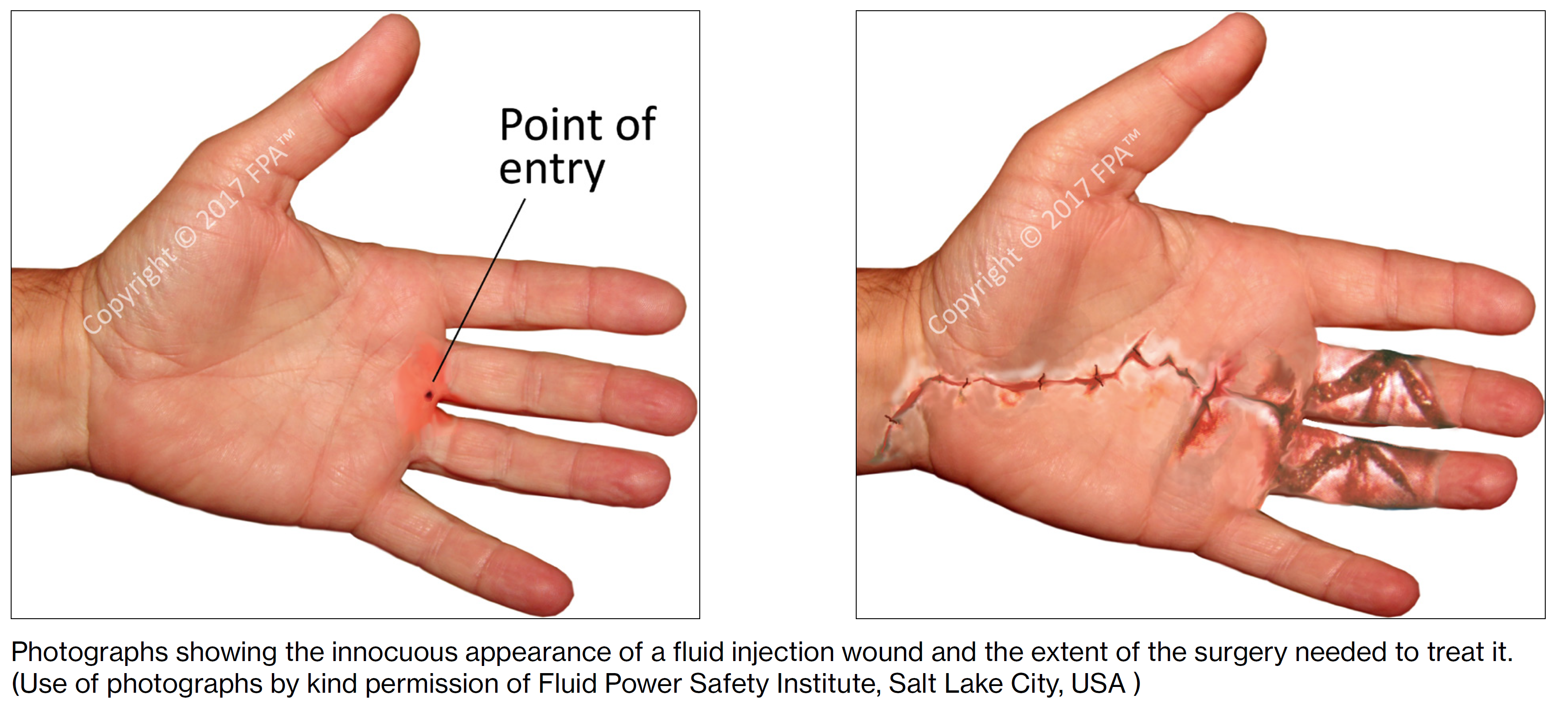 High-PressureFluidInjectionInjuriesArtic
